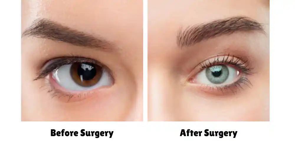 hooded eyes operation, hooded eyes surgery, plastic surgery for hooded eyes